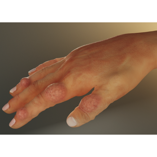 Gout Patien Hand Model Sample